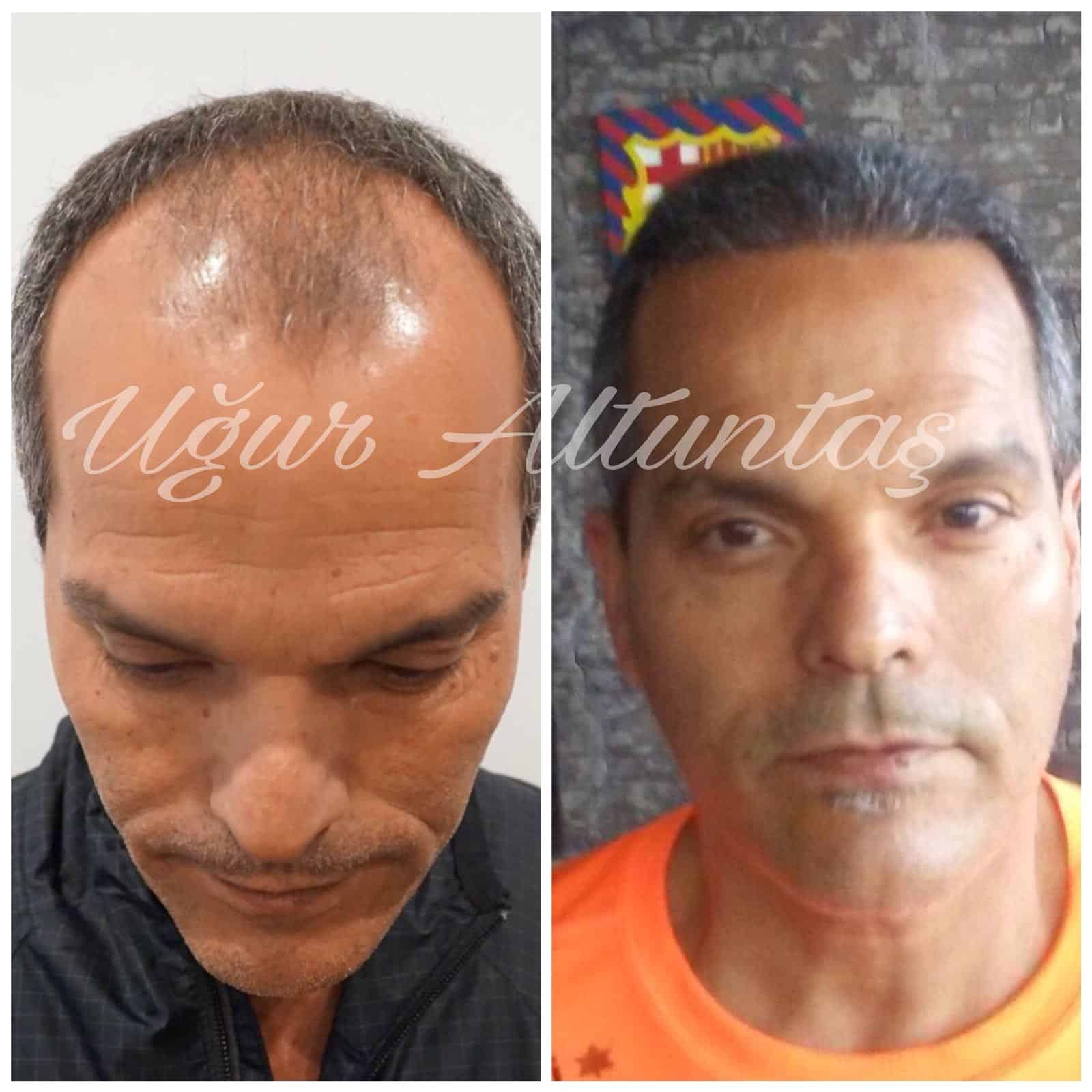 Global-health-fue-before-after-2