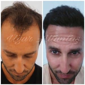 Global-health-fue-before-after-6