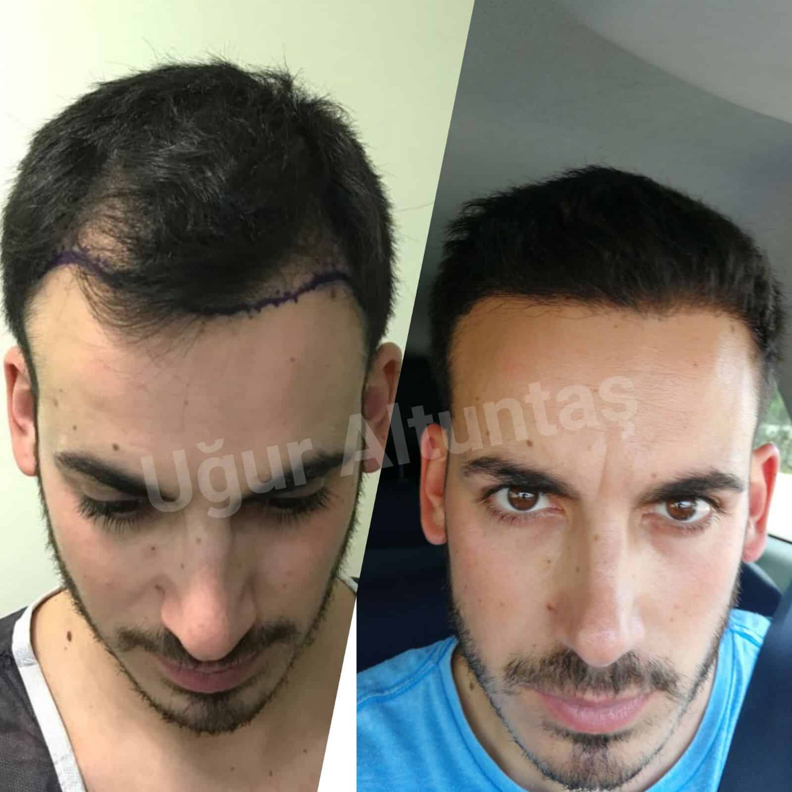 enxerto de cabelo istanbul antes e depois