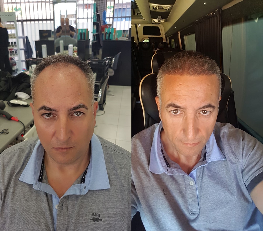 antes e depois de um enxerto de cabelo