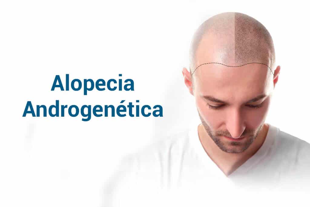 Alopécia androgenética