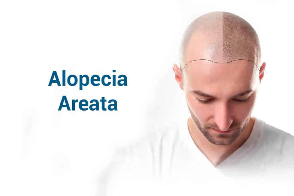 Alopécia areata