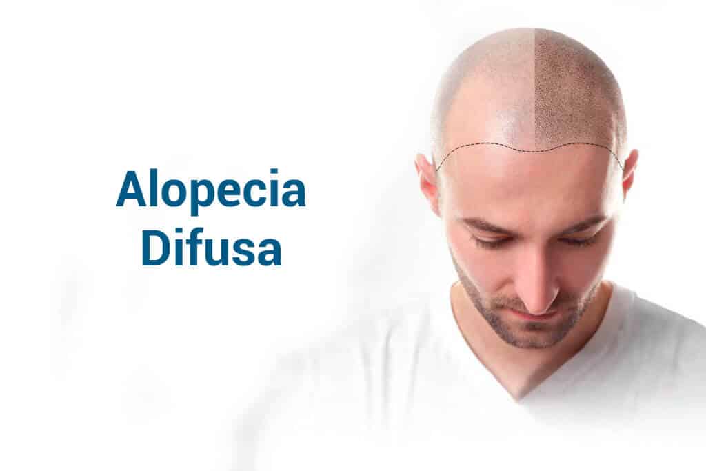 Alopécia difusa